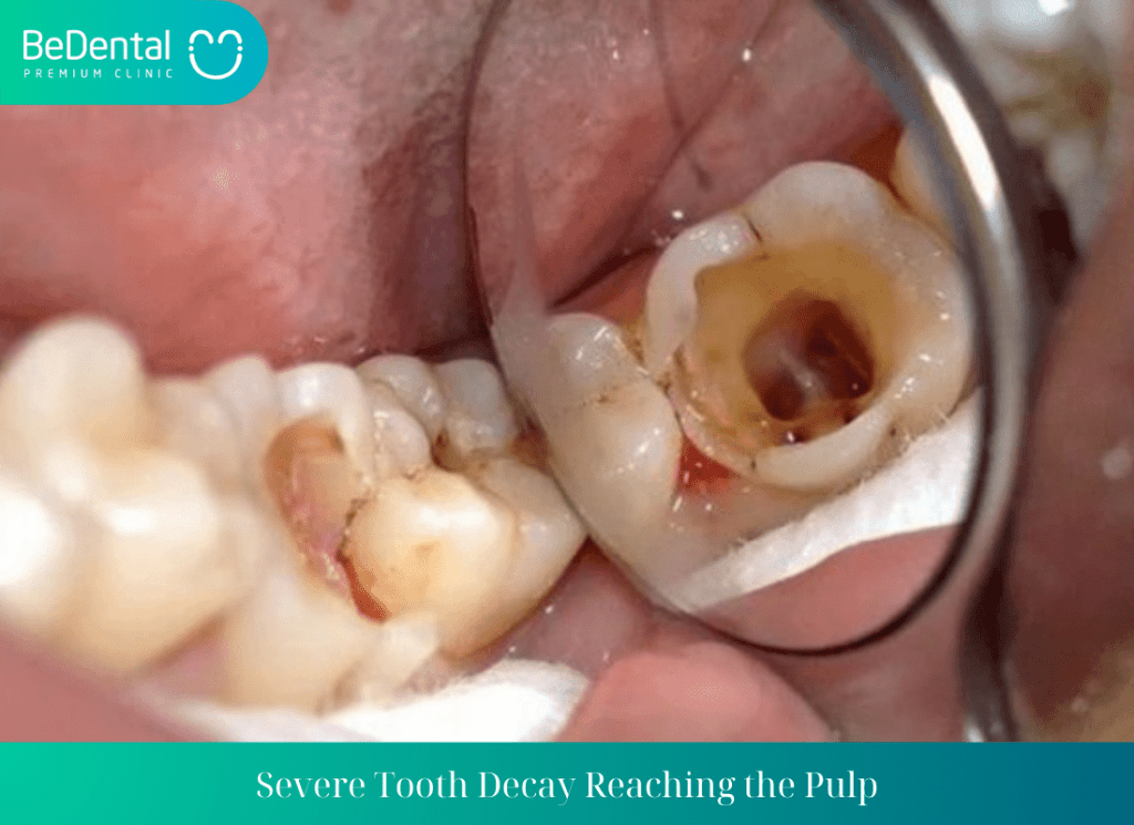 Severe Tooth Decay Reaching the Pulp