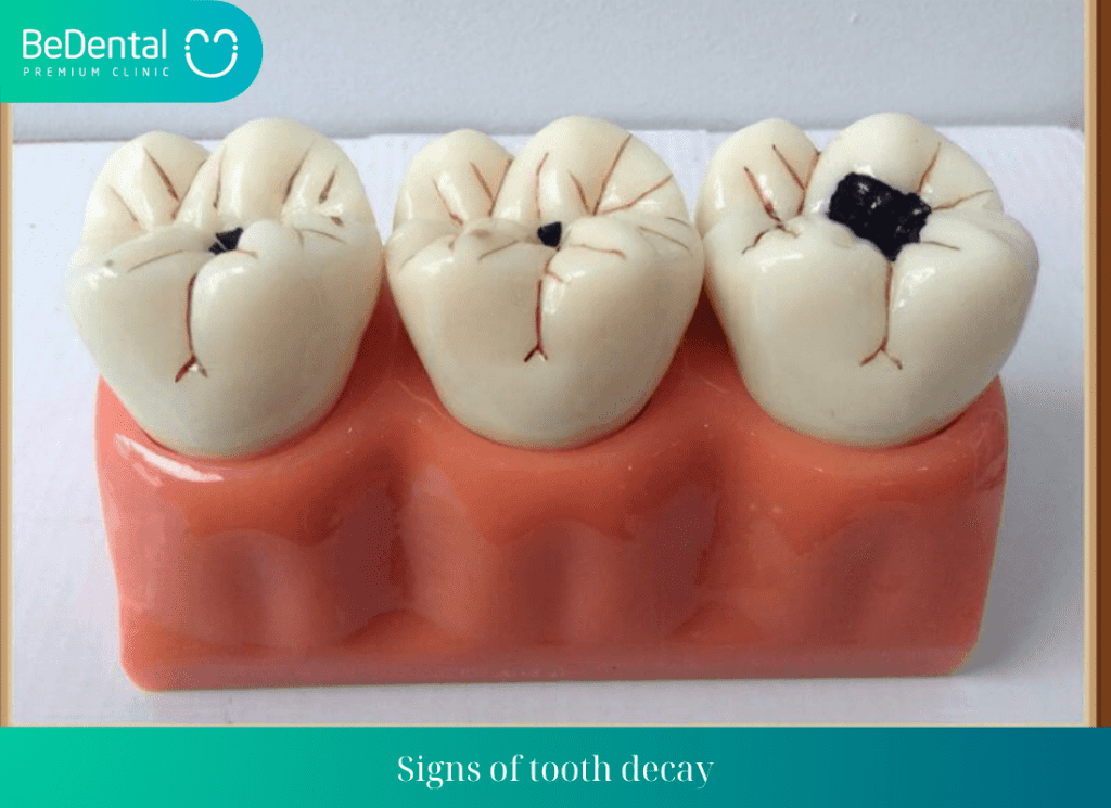 Signs of tooth decay