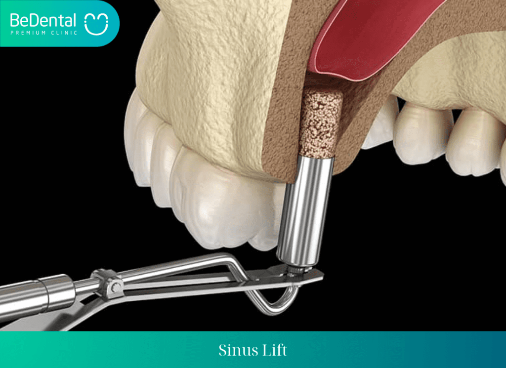 Sinus Lift