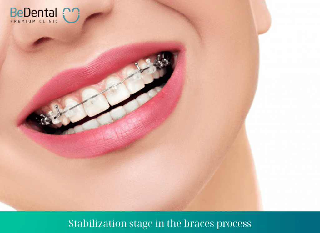 Stabilization stage in the braces process