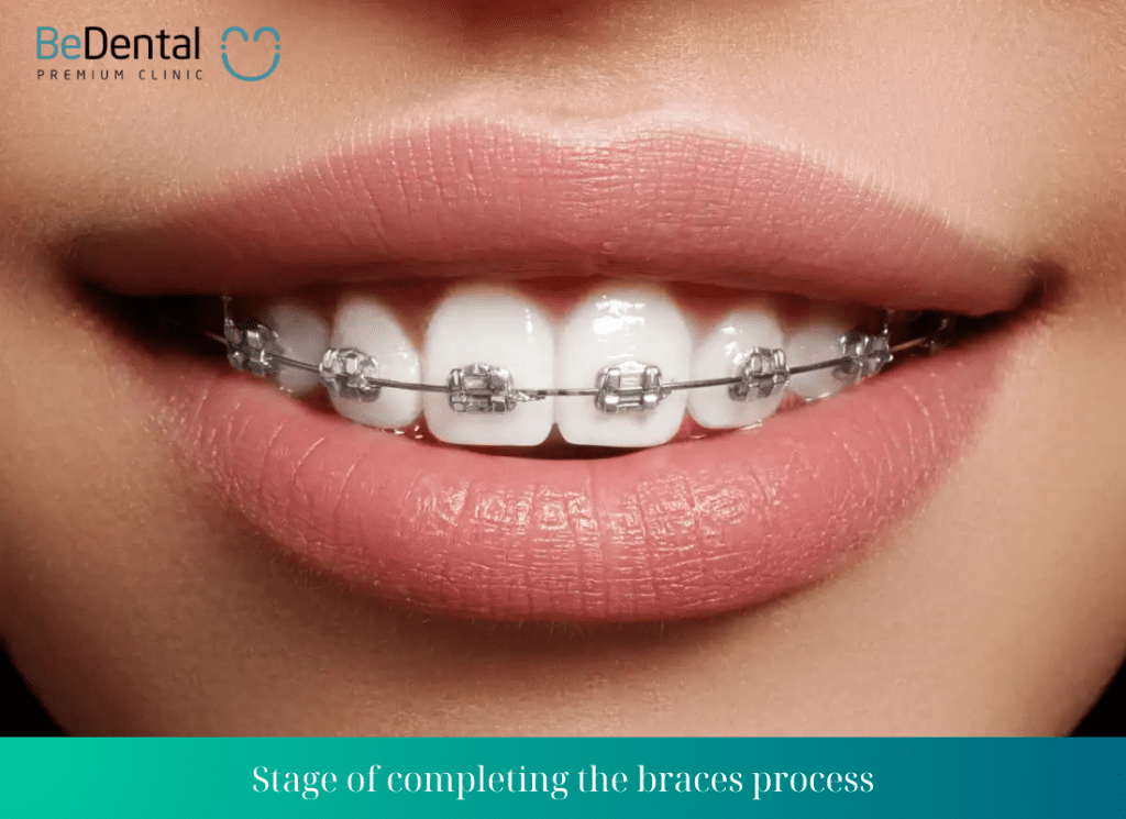 Stage of completing the braces process