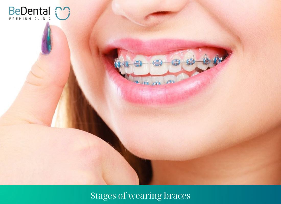 Stages of wearing braces