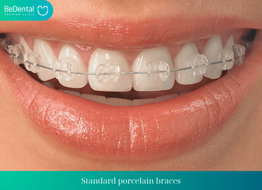 Standard porcelain braces