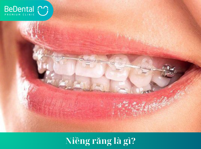 có nên niềng răng không ,Các loại niềng răng phổ biến hiện nay ,Niềng răng là gì