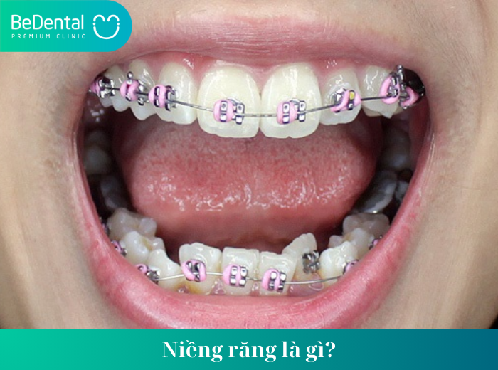 có nên niềng răng không ,Các loại niềng răng phổ biến hiện nay ,Niềng răng là gì