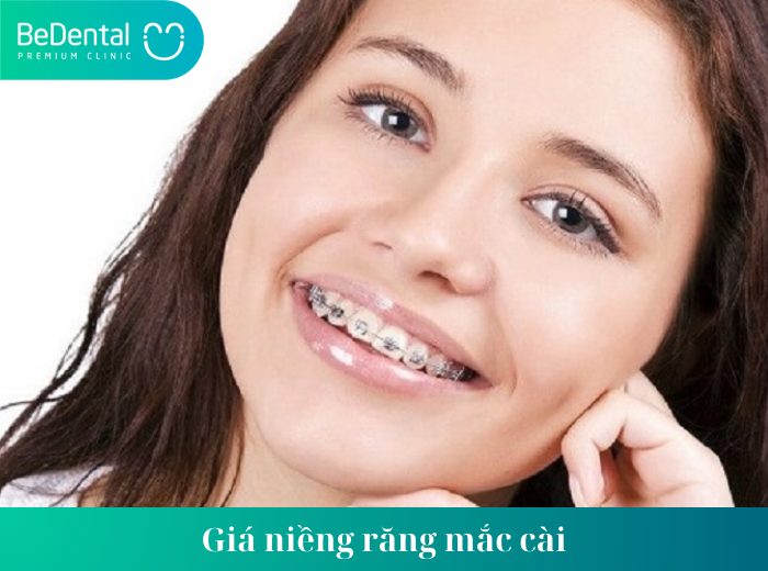 Giá niềng răng mắc cài