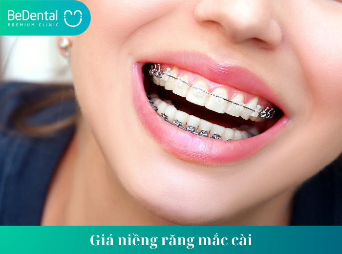 Giá niềng răng mắc cài