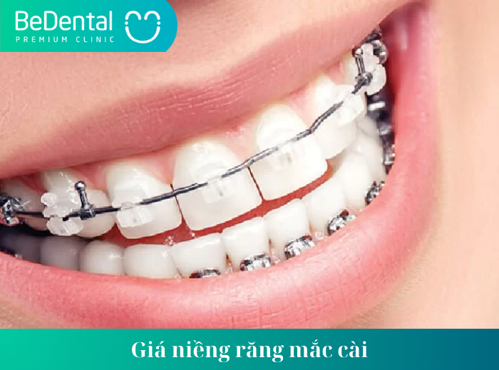 Giá niềng răng mắc cài