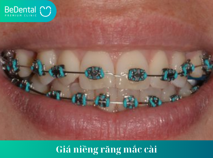 Giá niềng răng mắc cài