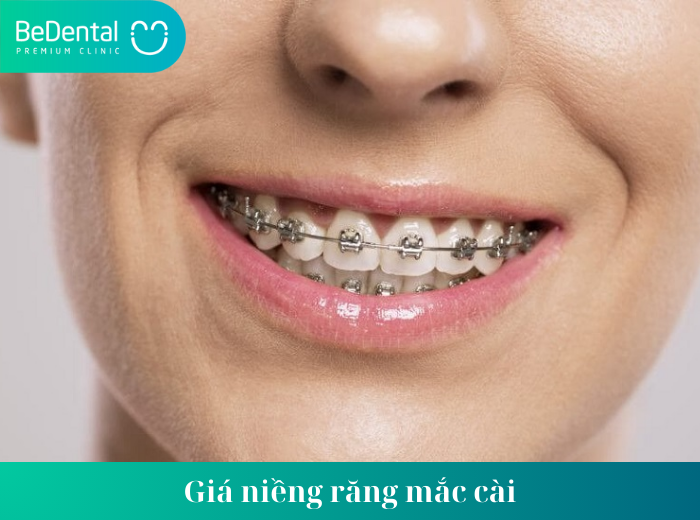 Giá niềng răng mắc cài