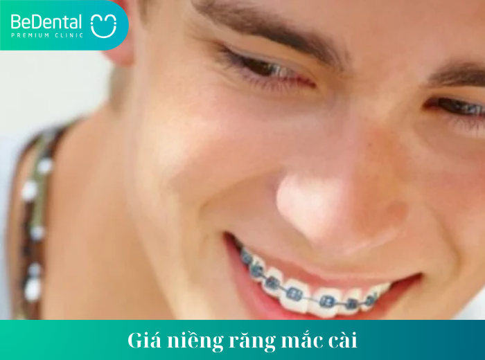 Giá niềng răng mắc cài