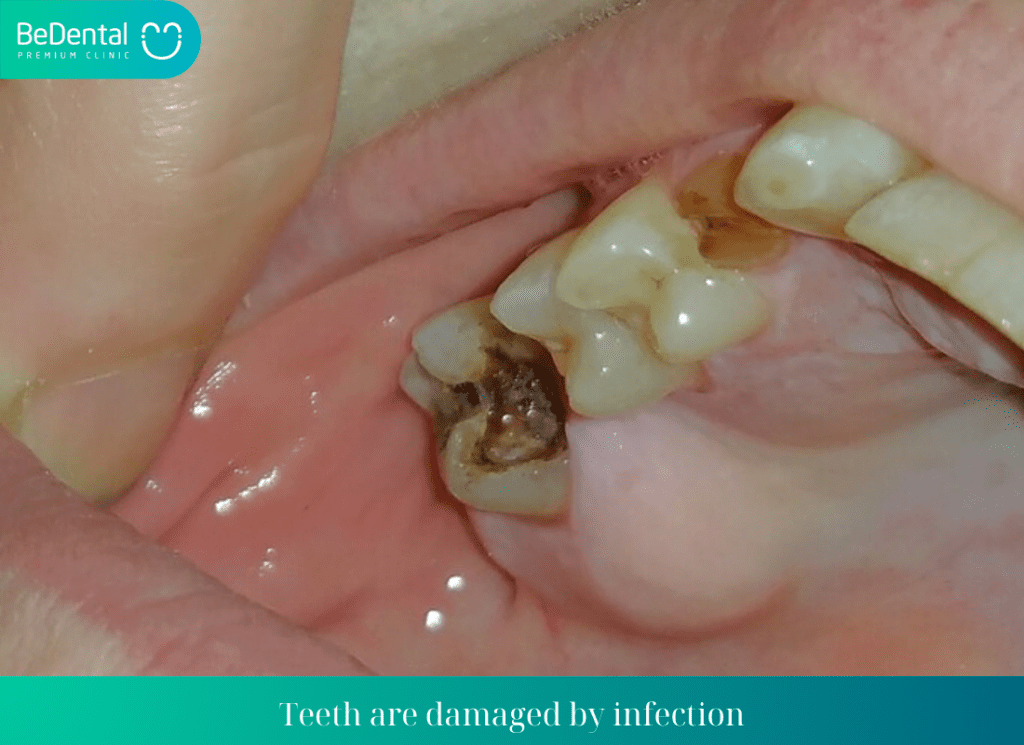 Teeth are damaged by infection