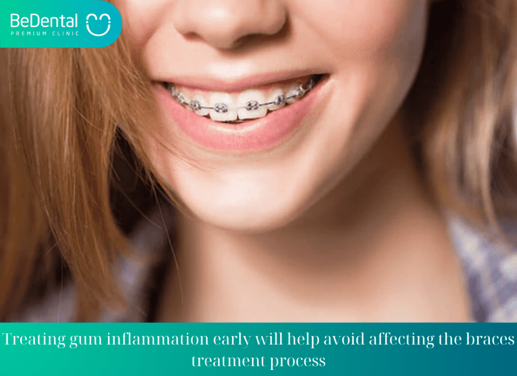 Treating gum inflammation early will help avoid affecting the braces treatment process