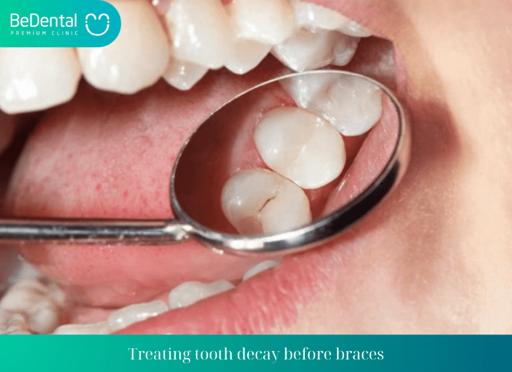 Treating tooth decay before braces