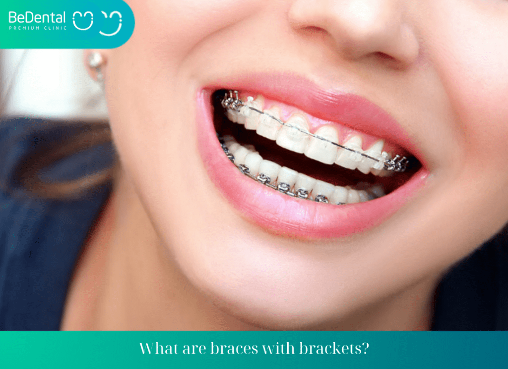 What are braces with brackets