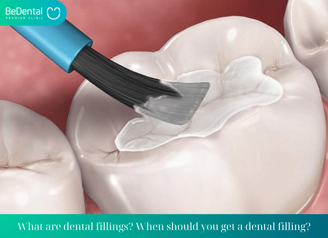 What are dental fillings