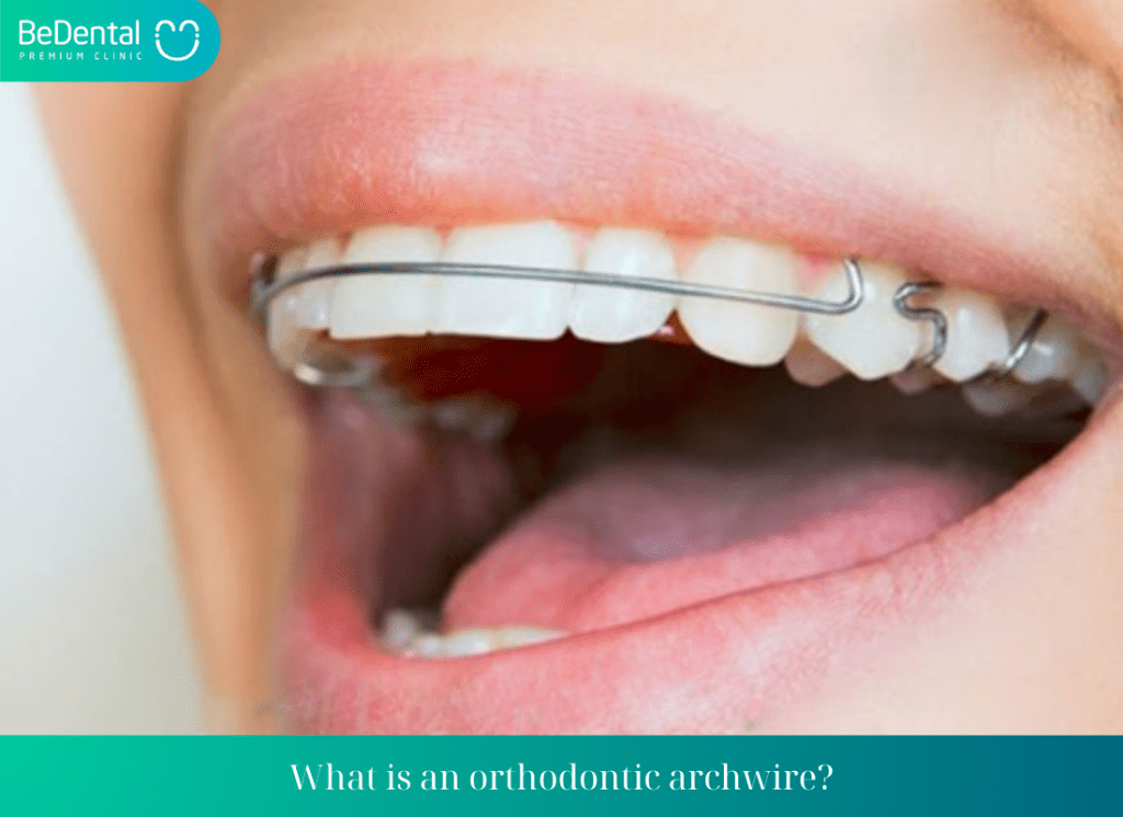 What is an orthodontic archwire