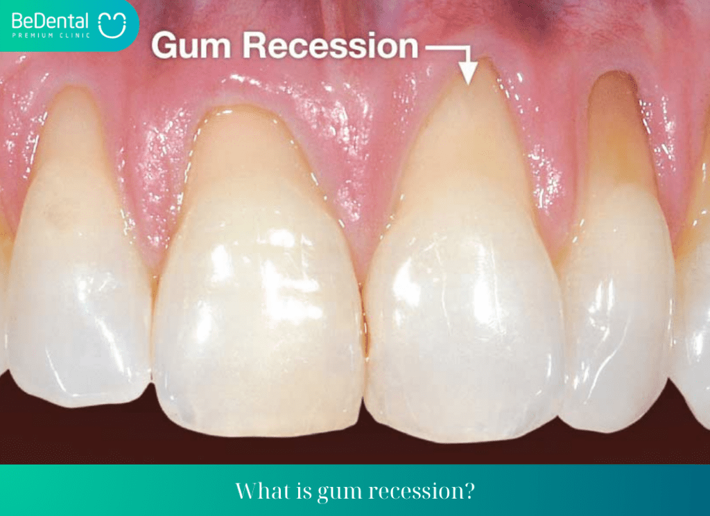 Signs of gum recession during braces