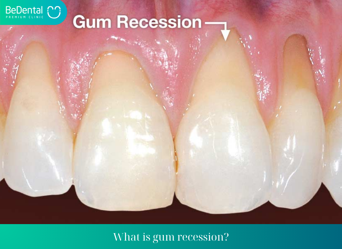 What is gum recession