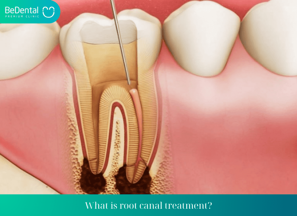 What is root canal treatment