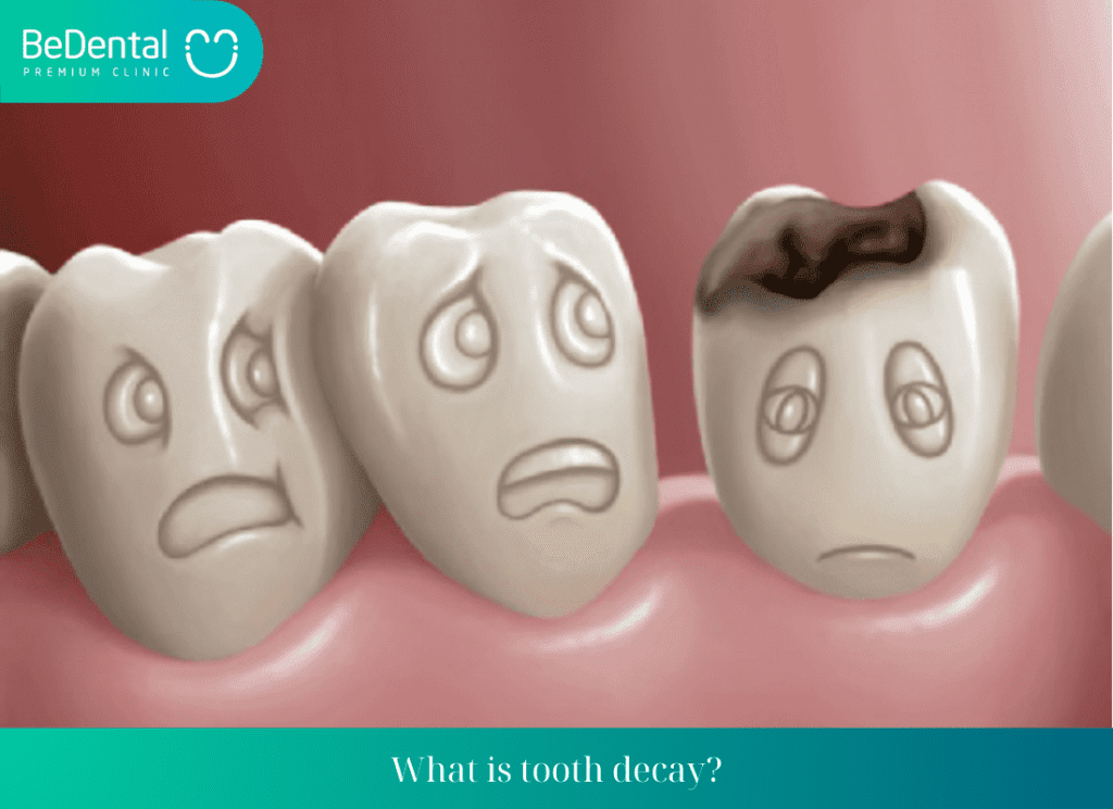 What is tooth decay