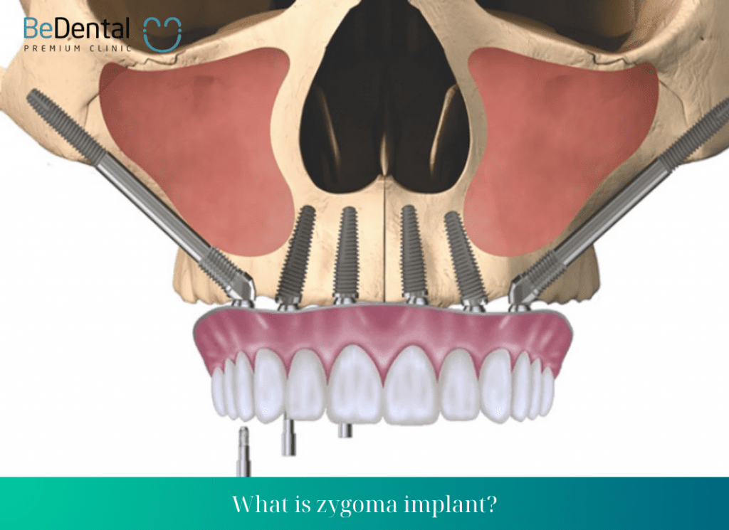 What is zygoma implant