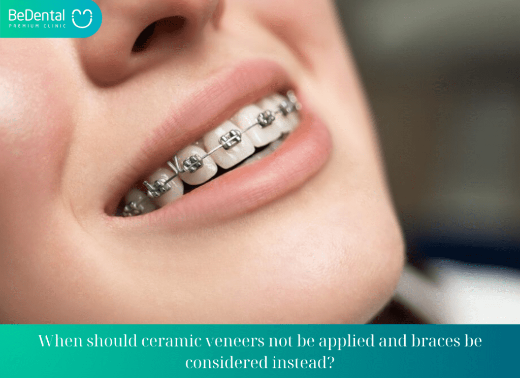 When should ceramic veneers not be applied and braces be considered instead