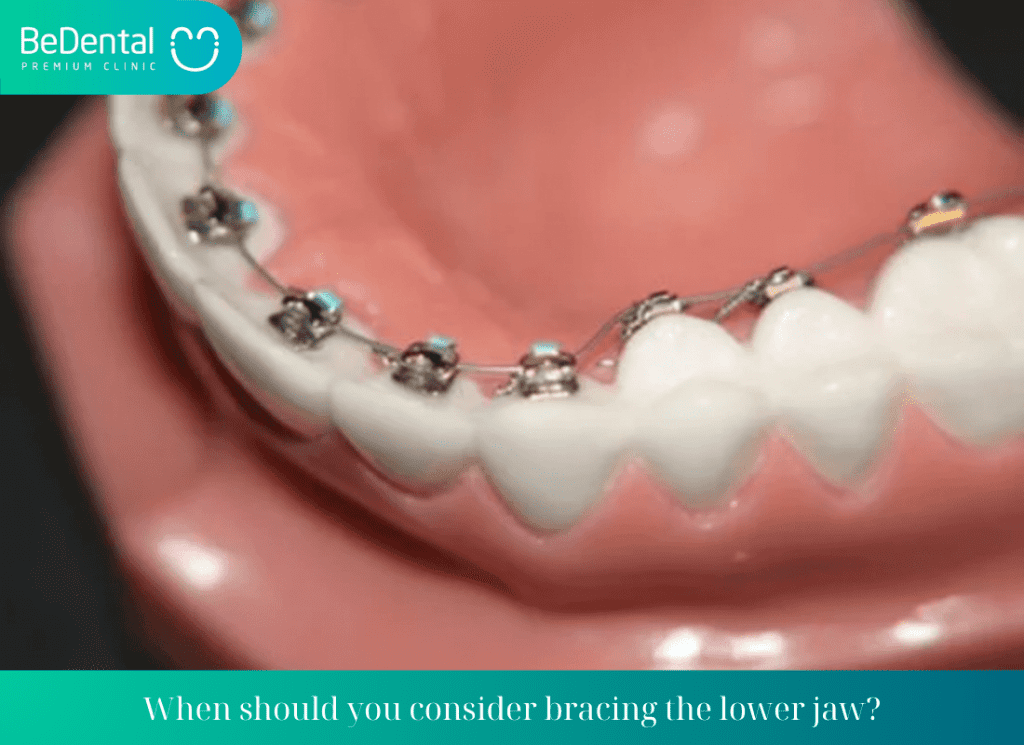 All About Lower Jaw Braces