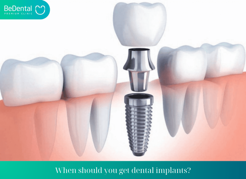 When to Get an Implant After Tooth Extraction