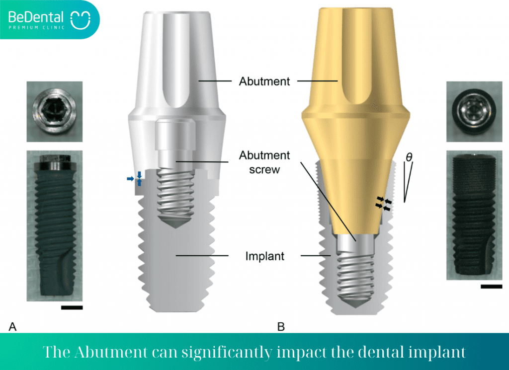 the Abutment can significantly impact the dental implant 1