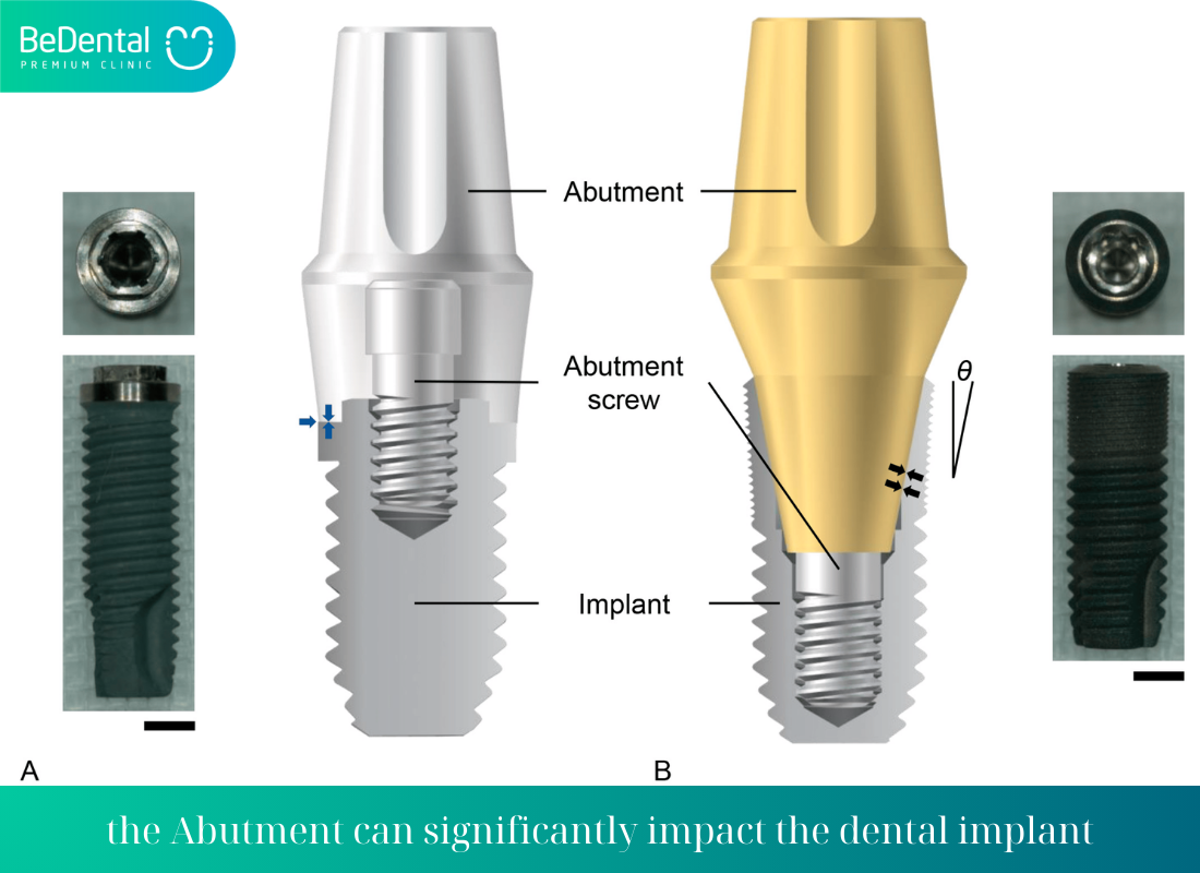 the Abutment can significantly impact the dental implant