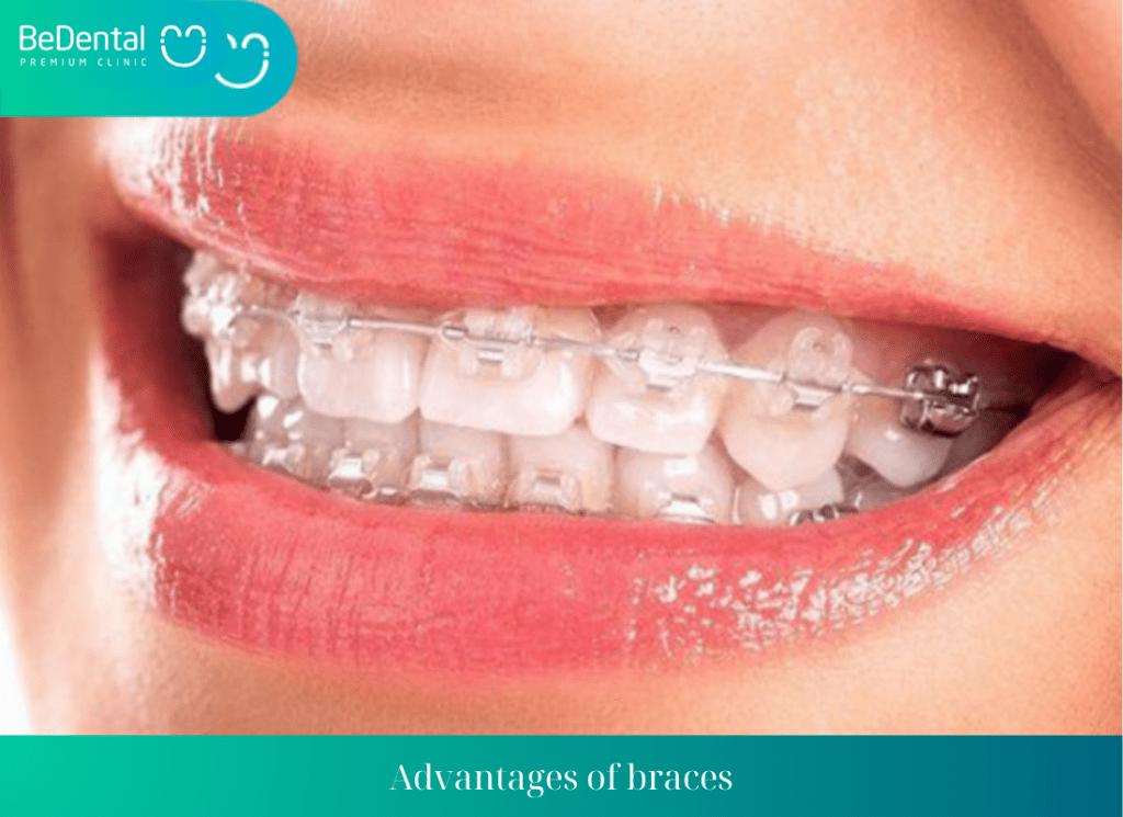 Advantages of braces