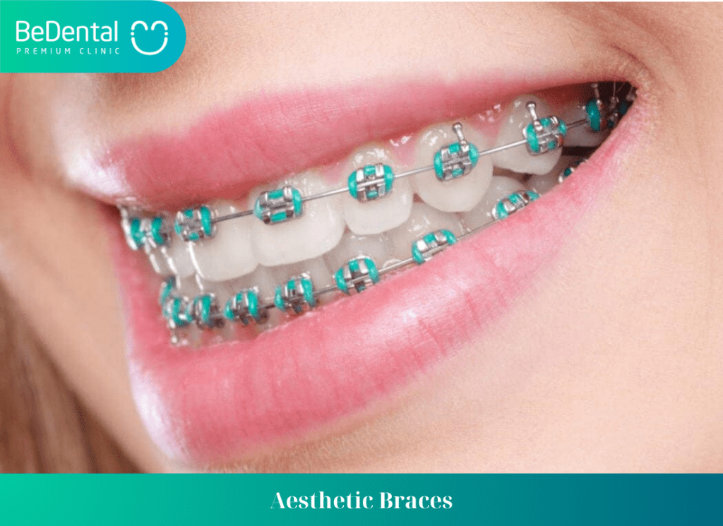 Aesthetic Braces