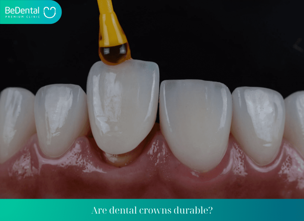 Are dental crowns durable