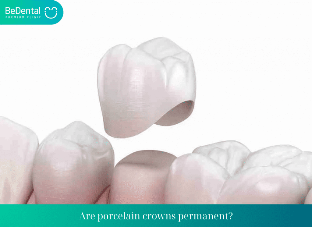 Are porcelain crowns permanent