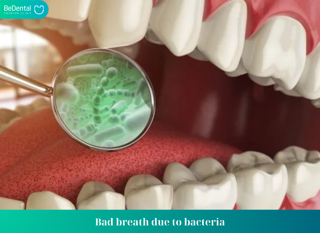 Bad breath due to bacteria