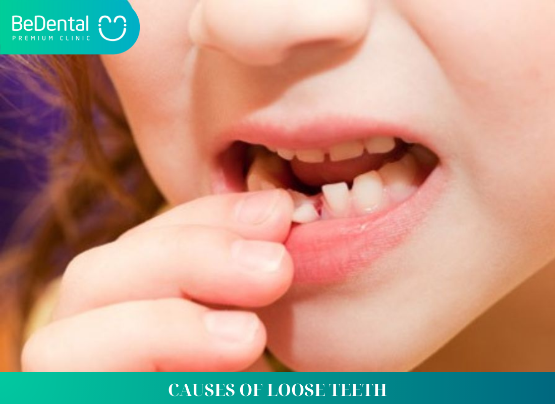 CAUSES OF LOOSE TEETH