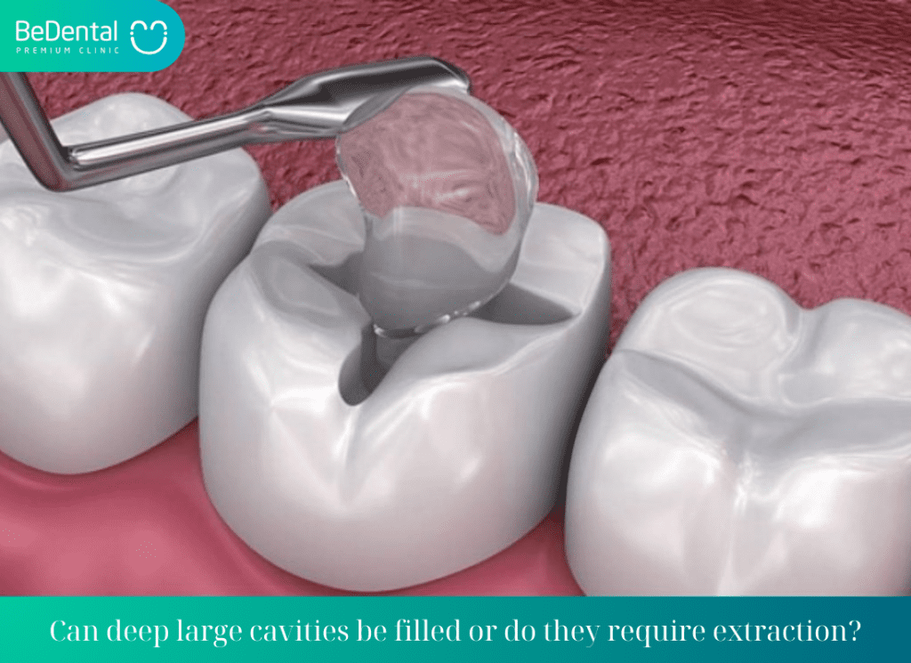 Can deep large cavities be filled or do they require extraction