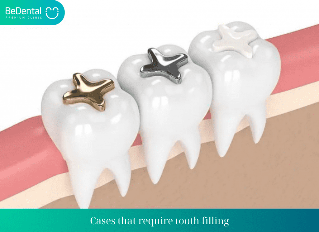 Cases that require tooth filling