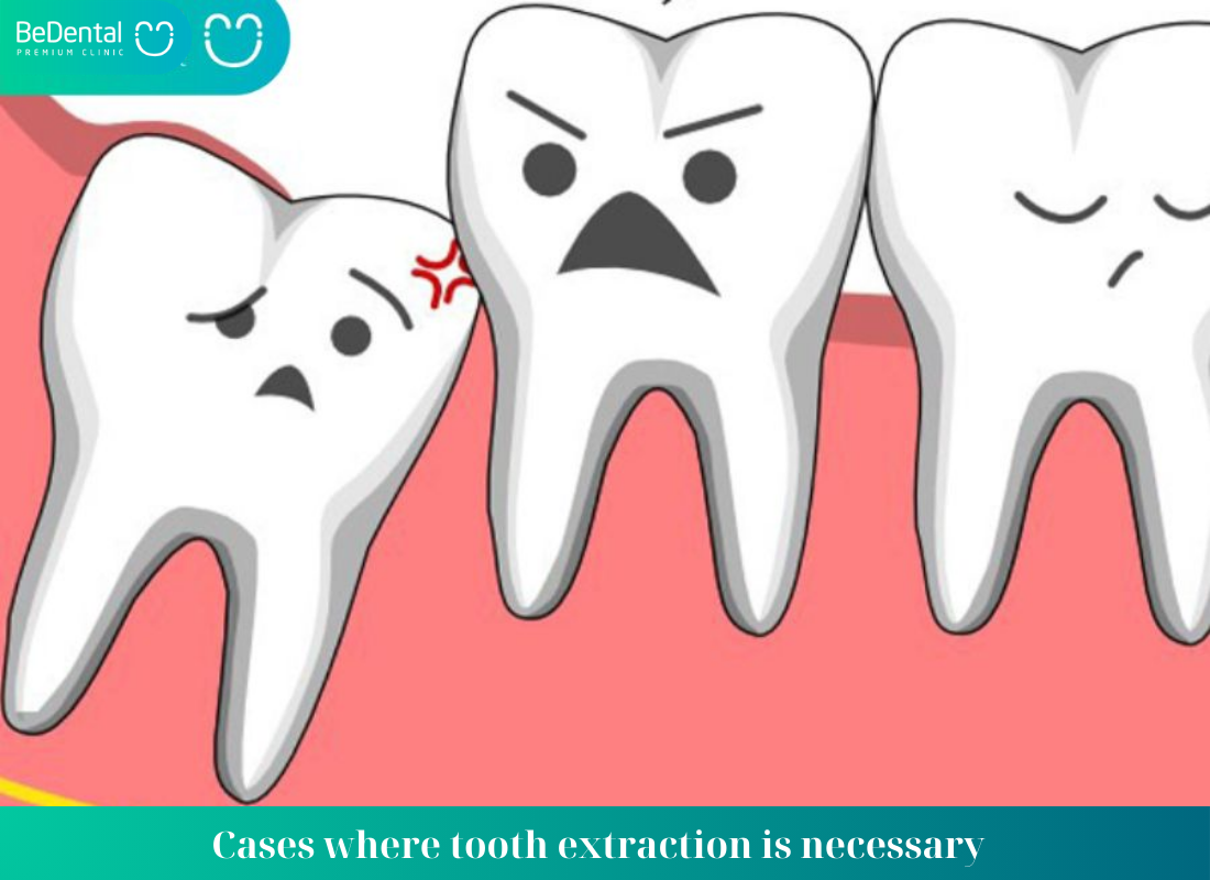 Cases where tooth extraction is necessary