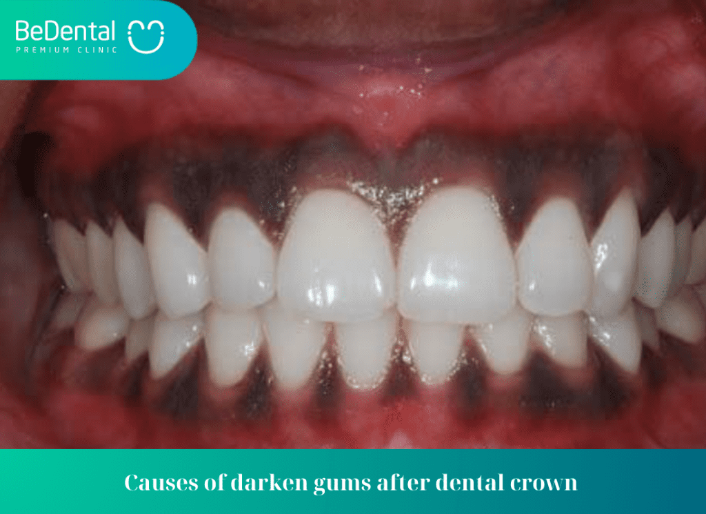 Darkened Gums after Dental Crowns