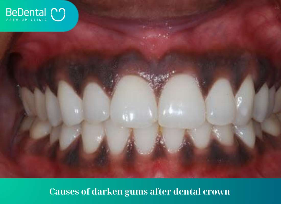 Causes of darken gums after dental crown