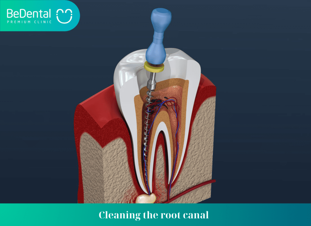 Cleaning the root canal