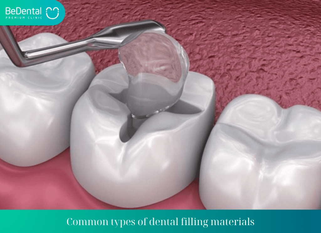 Common types of dental filling materials