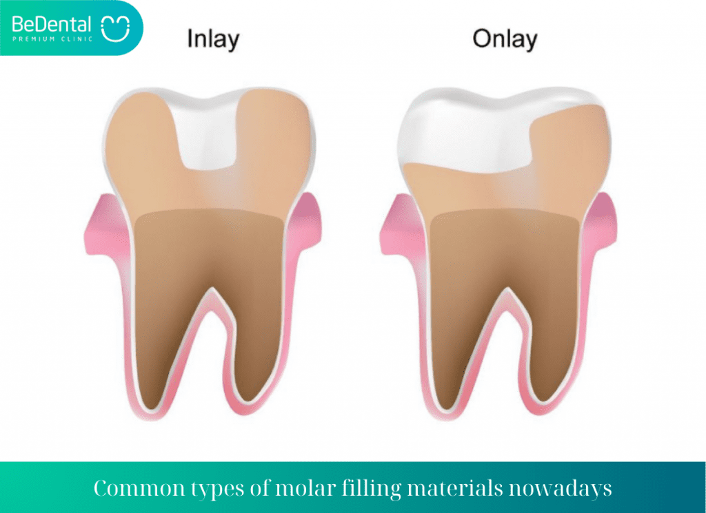 How Much Does Dental Filling Cost