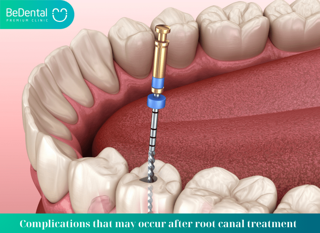 Complications that may occur after root canal treatment