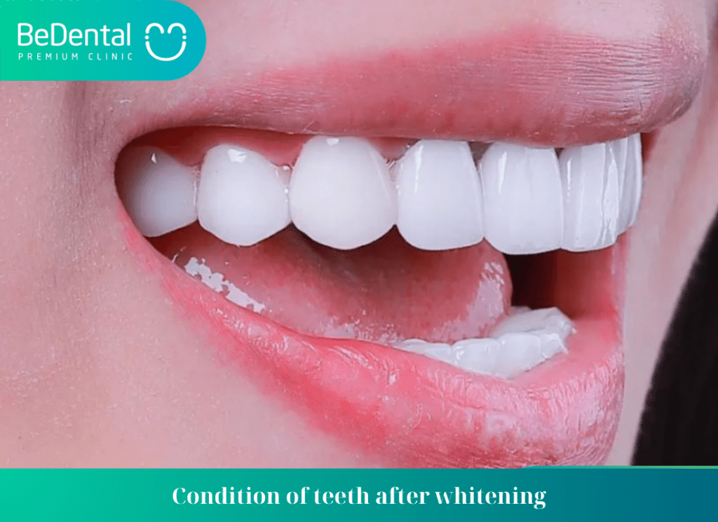 Condition of teeth after whitening 1