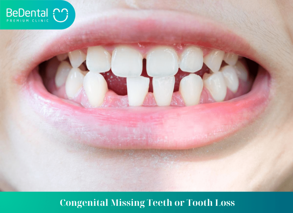 Congenital Missing Teeth or Tooth Loss