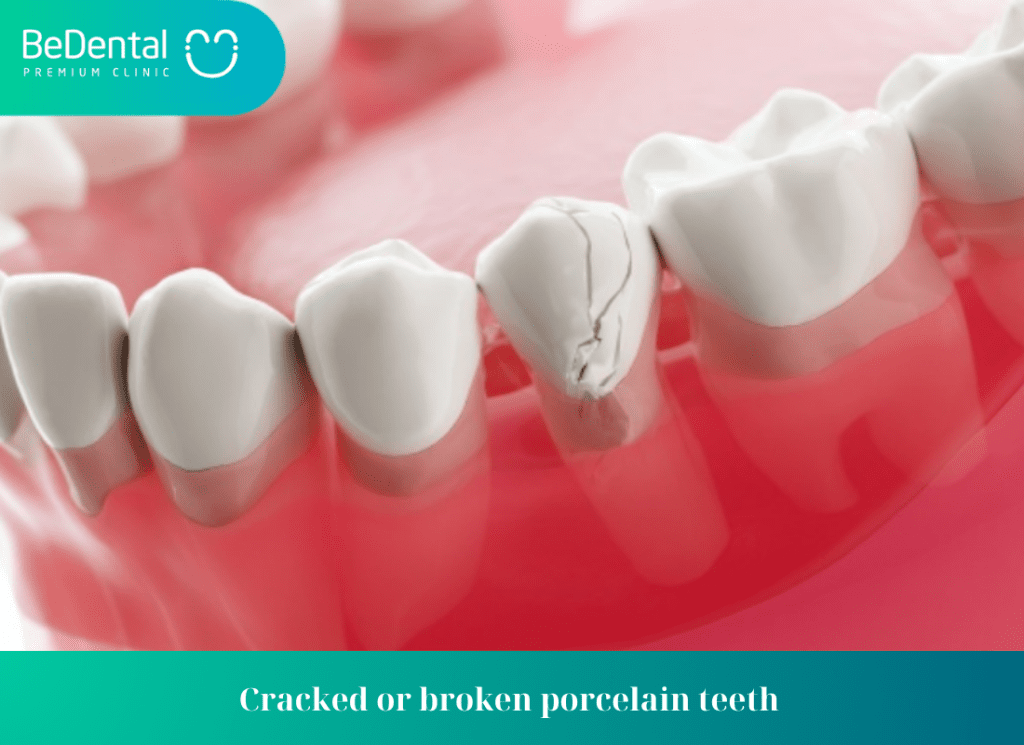 Cracked or broken porcelain teeth