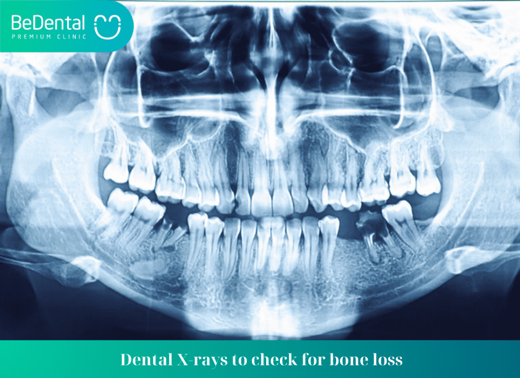 Dental X rays to check for bone loss